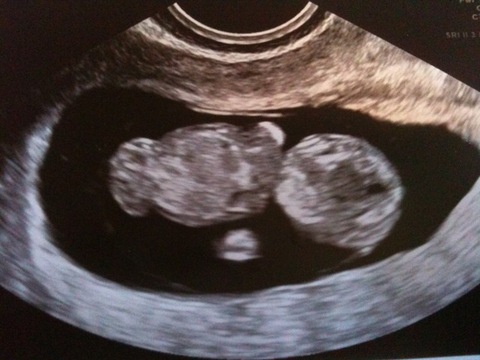 Ultrasound at 1.5 weeks.